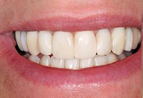 Dino M. DeFilippis, DDS | Oral Cancer Screening, Extractions and Cyst Abscess Removal