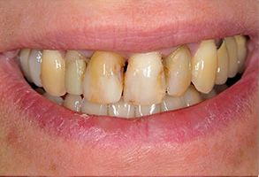 Dino M. DeFilippis, DDS | Implant Dentistry, Sinus Augmentation and Apicoectomy